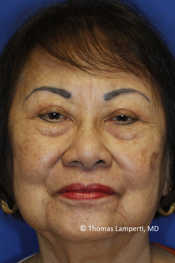 After Blepharoplasty Frontal