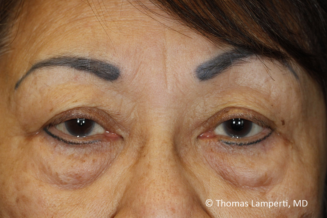 Before Blepharoplasty Frontal Detail