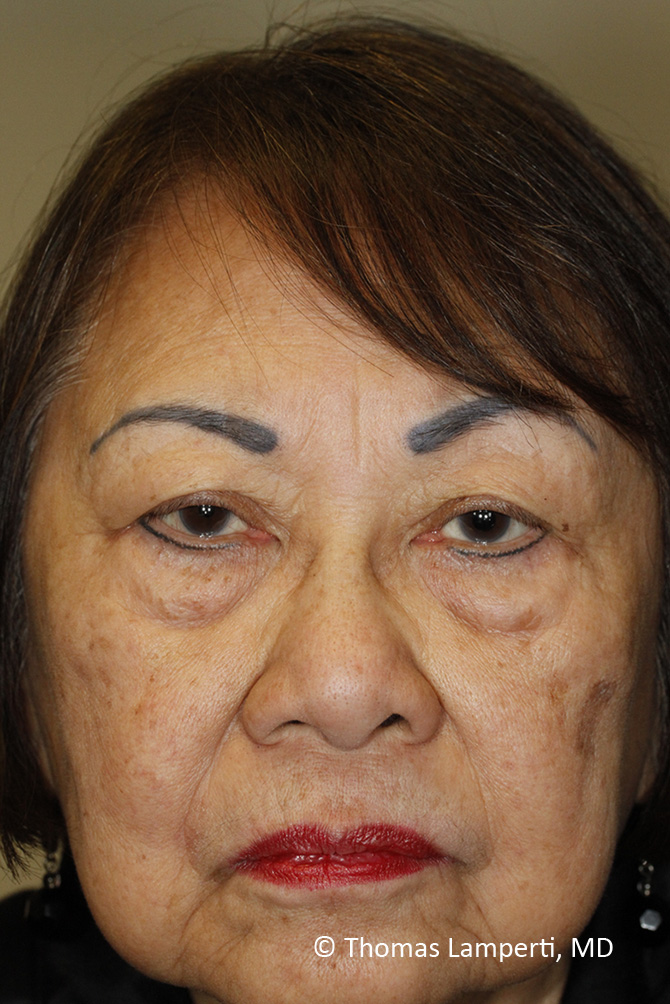 Before Blepharoplasty Frontal