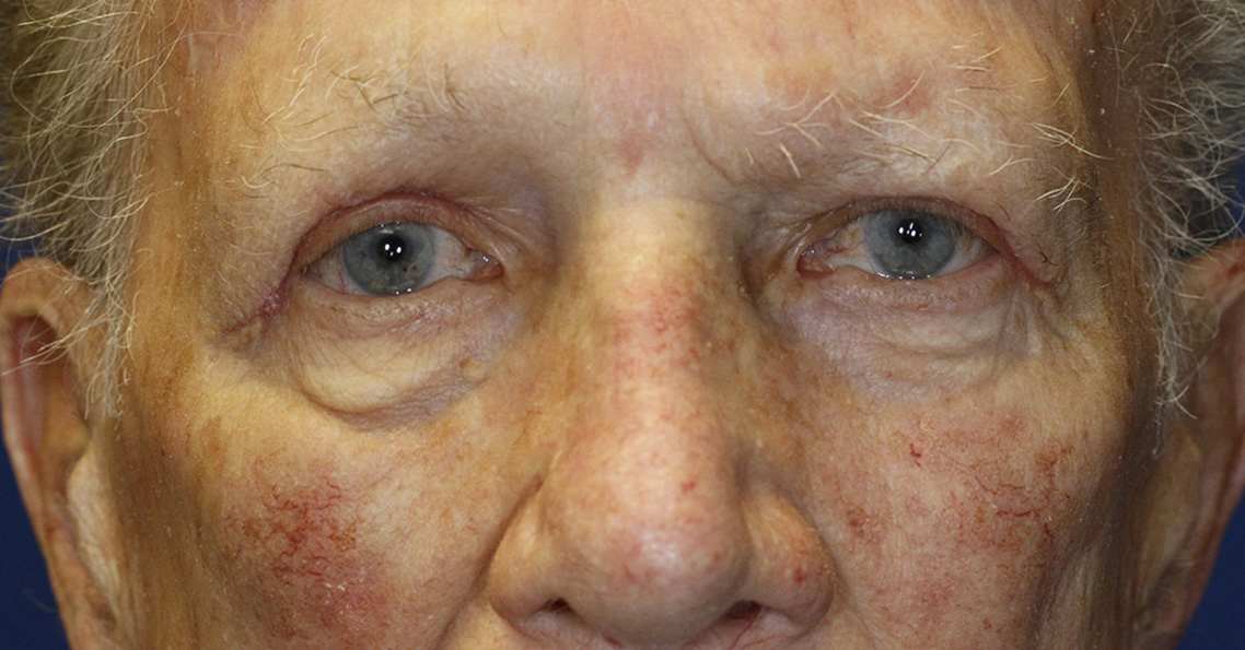 After Blepharoplasty Photo