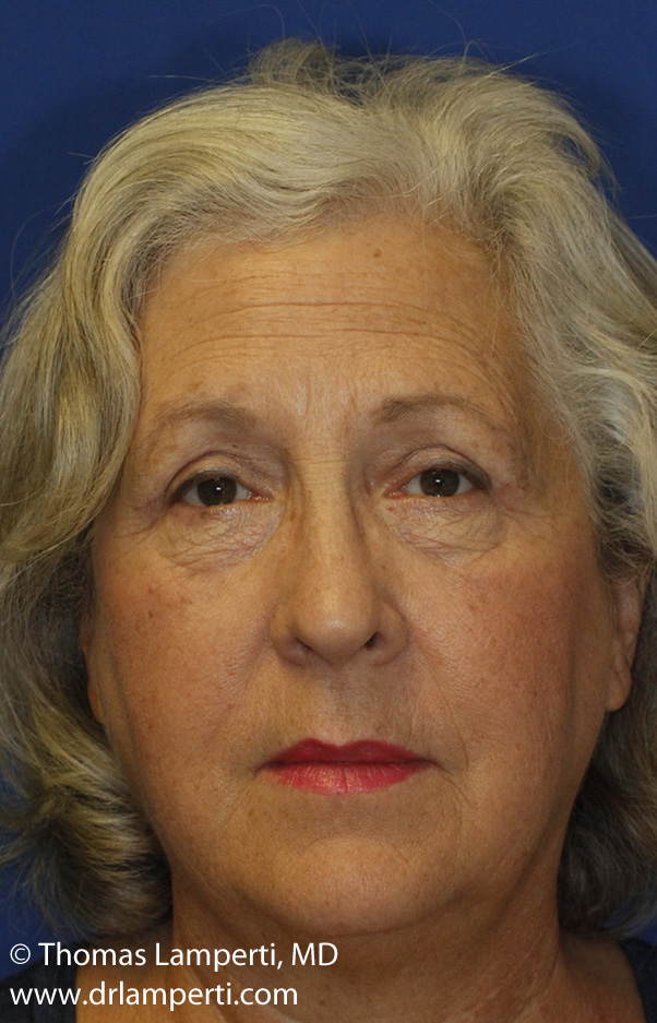 Blepharoplasty After Frontal