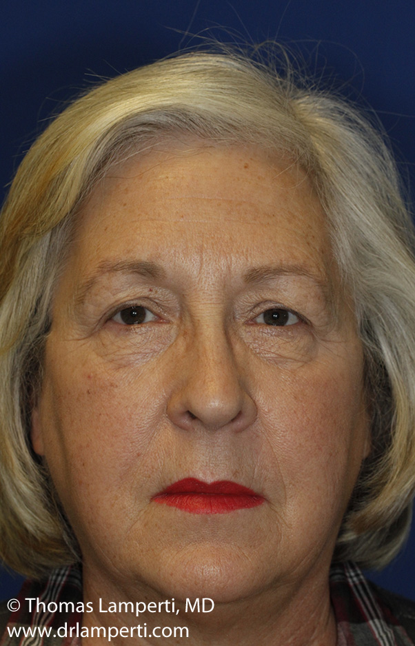 Blepharoplasty Before Frontal