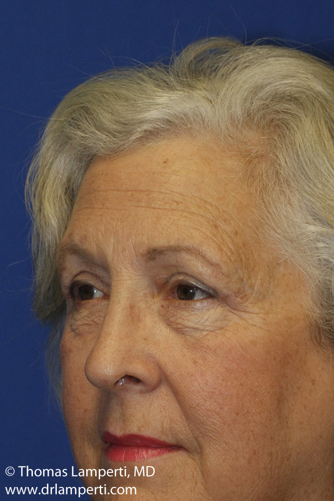 Blepharoplasty After Left Oblique