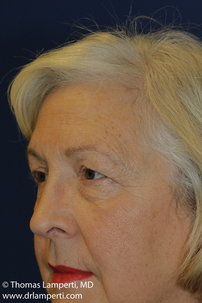 Blepharoplasty Before Left Oblique
