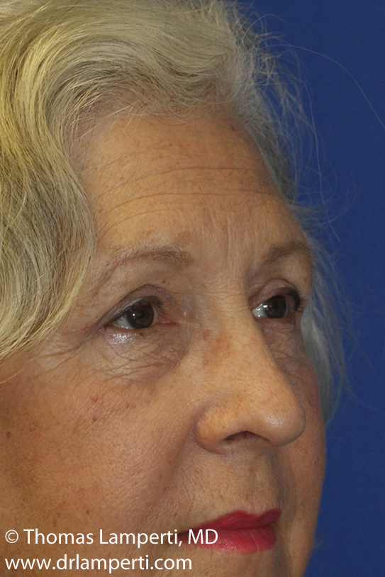 Blepharoplasty After Right Oblique