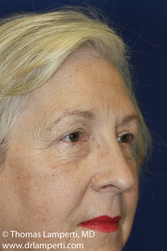 Blepharoplasty Before Right Oblique