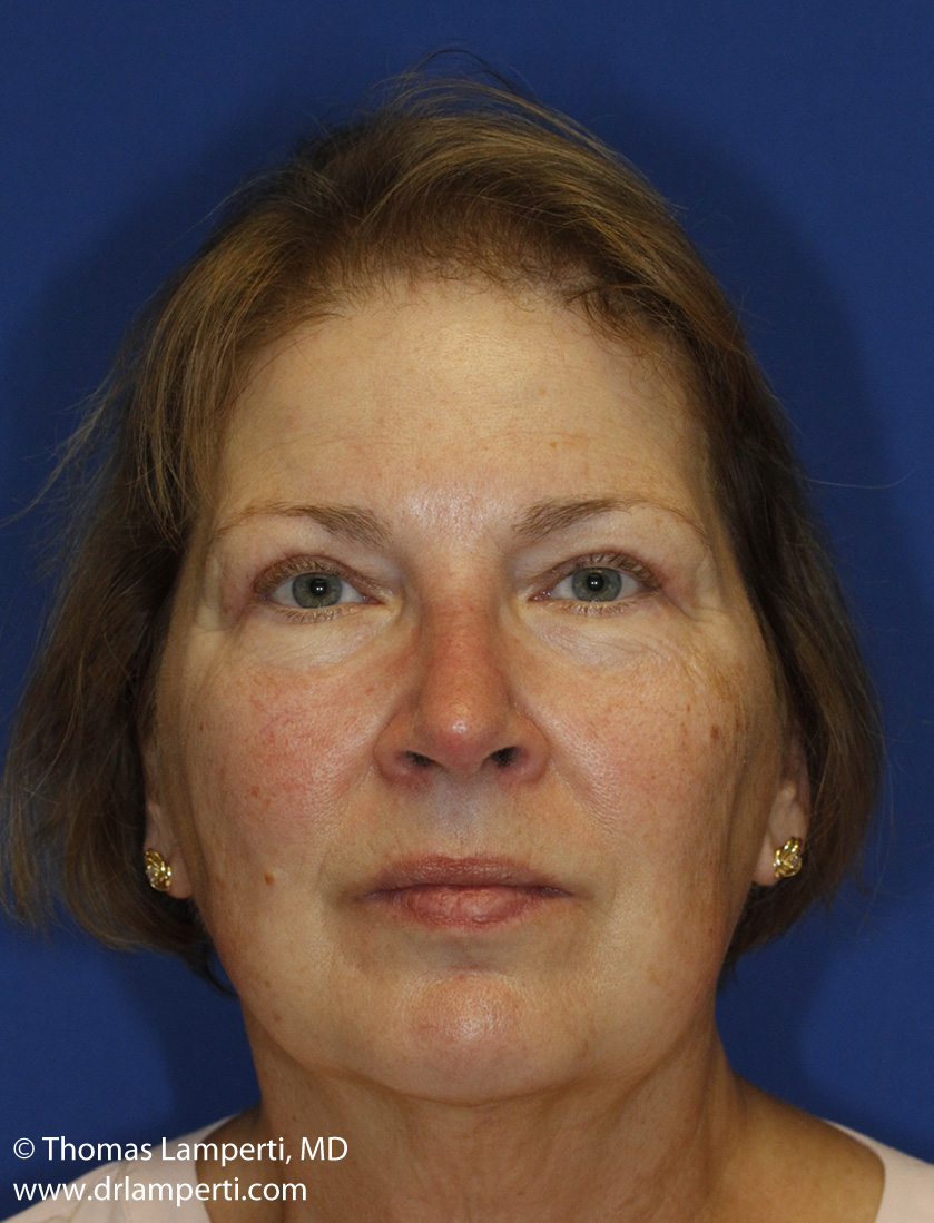 Blepharoplasty After Frontal