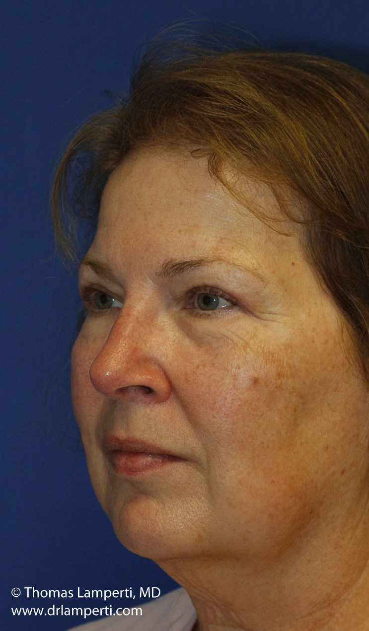 Blepharoplasty After L Oblique