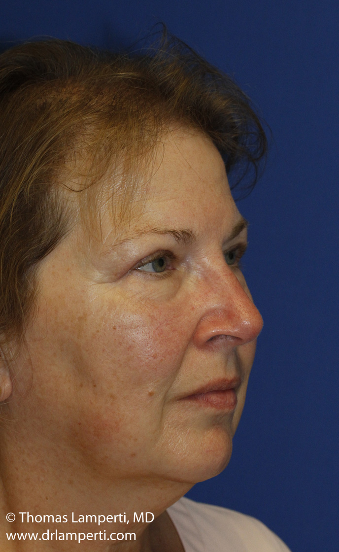 Blepharoplasty After R Oblique