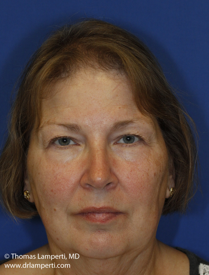 Blepharoplasty Before Frontal