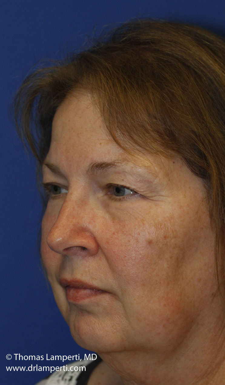 Blepharoplasty Before L Oblique