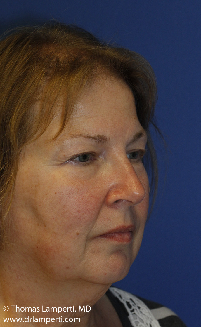 Blepharoplasty Before R Oblique