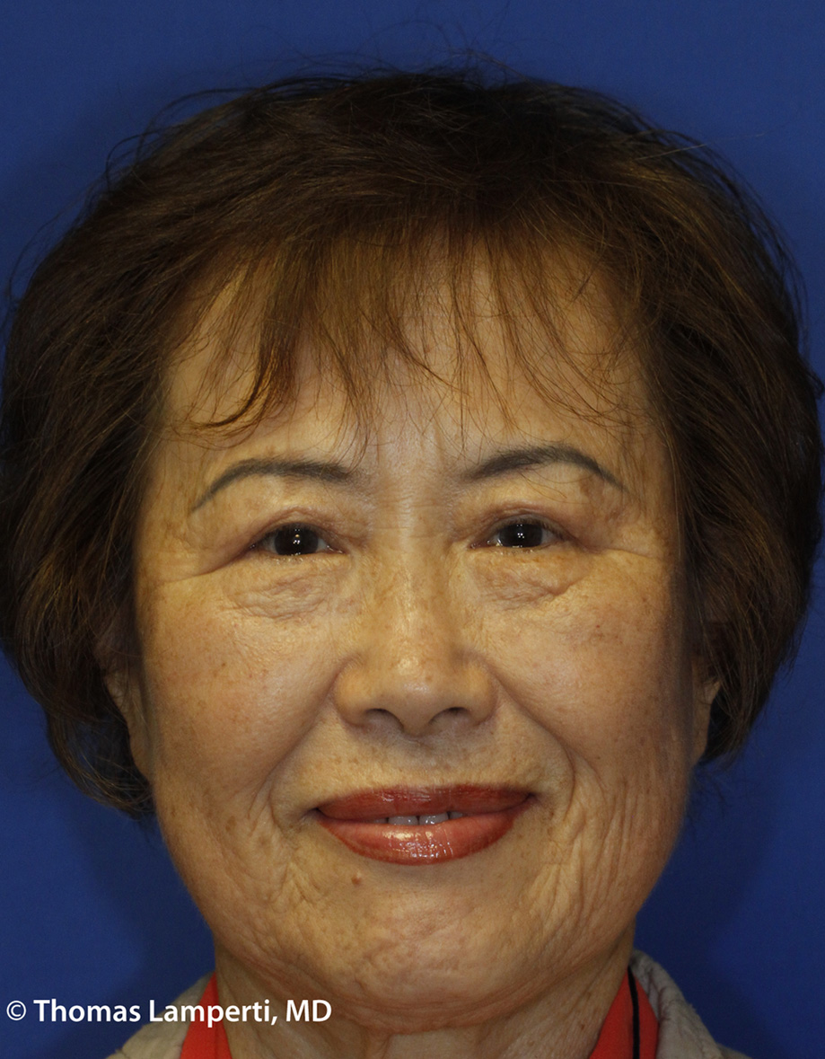 Blepharoplasty After Frontal