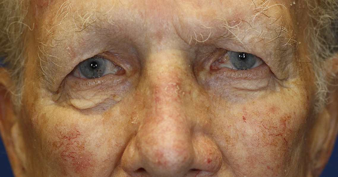 Before Blepharoplasty Photo