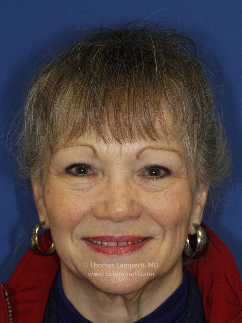 Blepharoplasty Frontal After