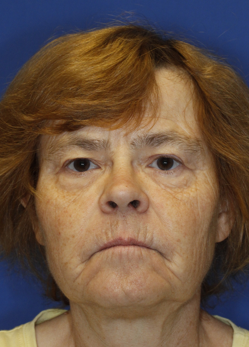 Blepharoplasty before photo