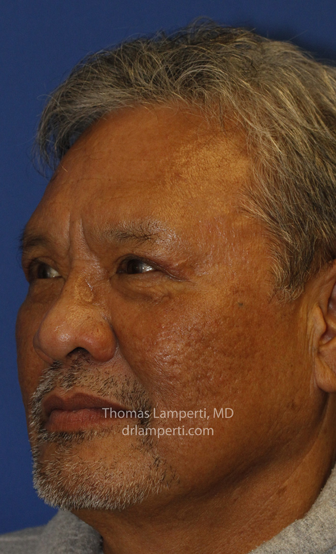 Blepharoplasty After L Oblique