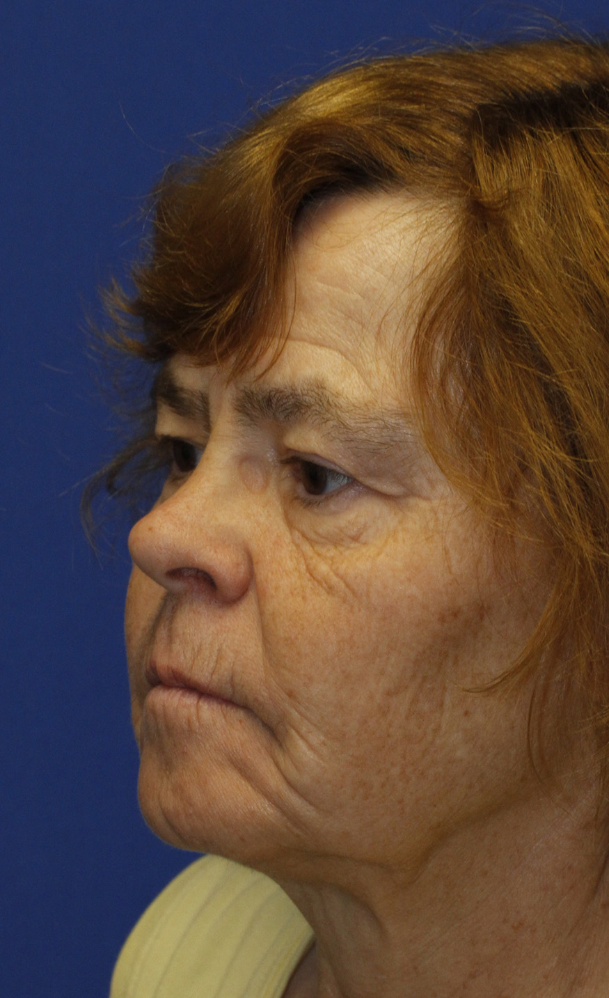 Blepharoplasty before photo