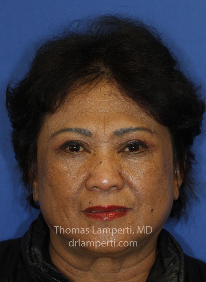 Blepharoplasty After Frontal