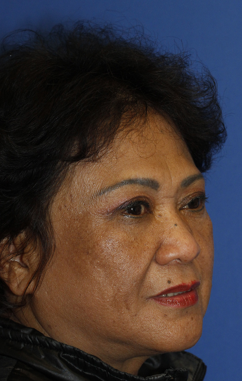 Blepharoplasty After R Oblique