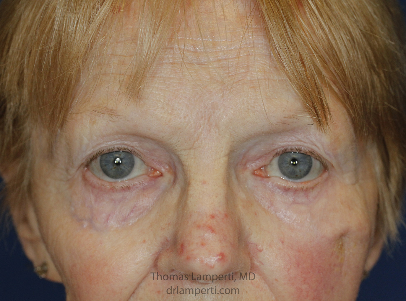 After Ectropion Repair Frontal