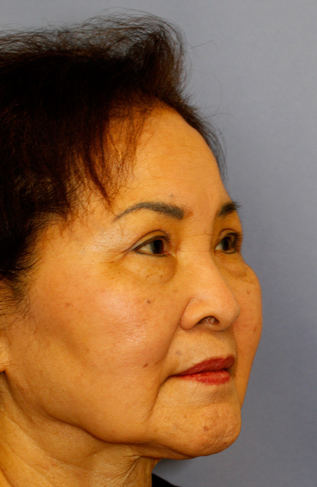 Before blepharoplasty photo