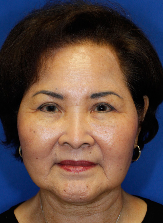 After blepharoplasty photo