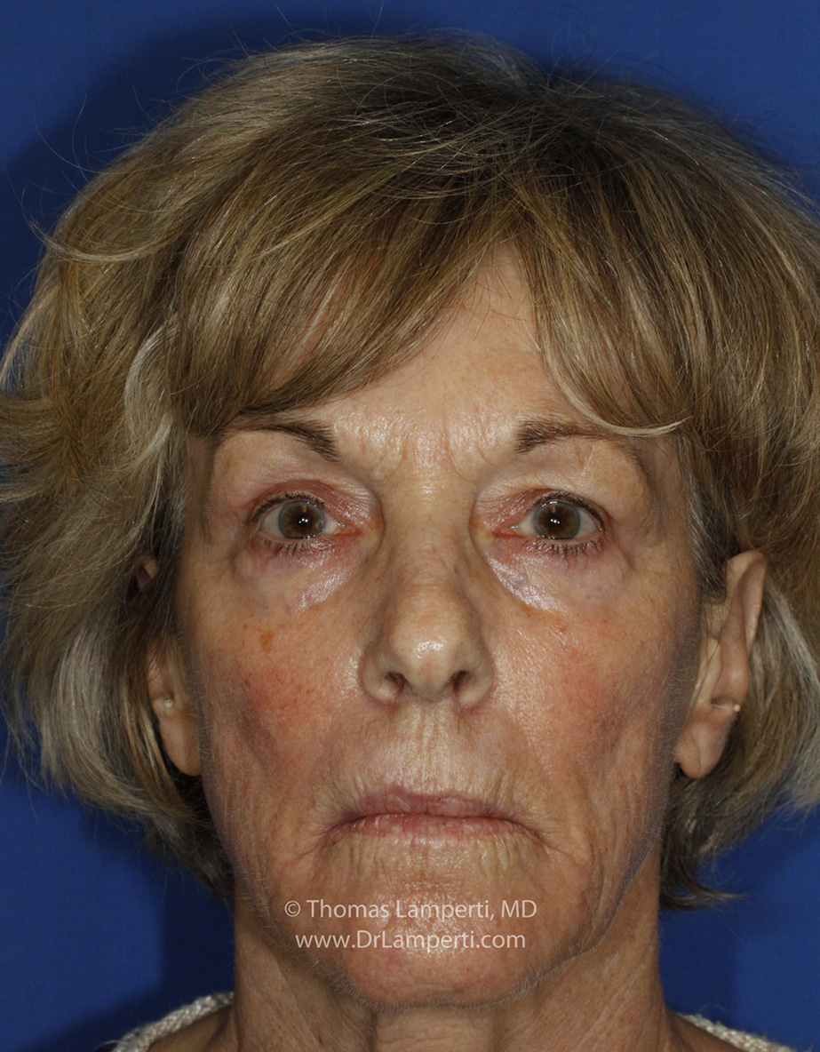 After Blepharoplasty Frontal