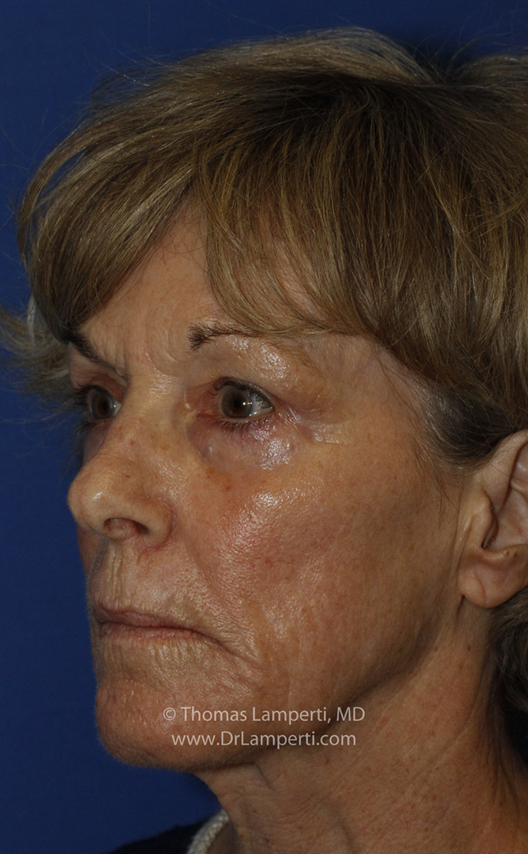 After Blepharoplasty L Oblique