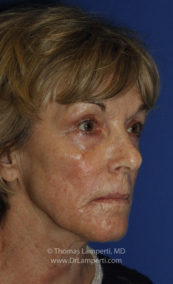 After Blepharoplasty R Oblique