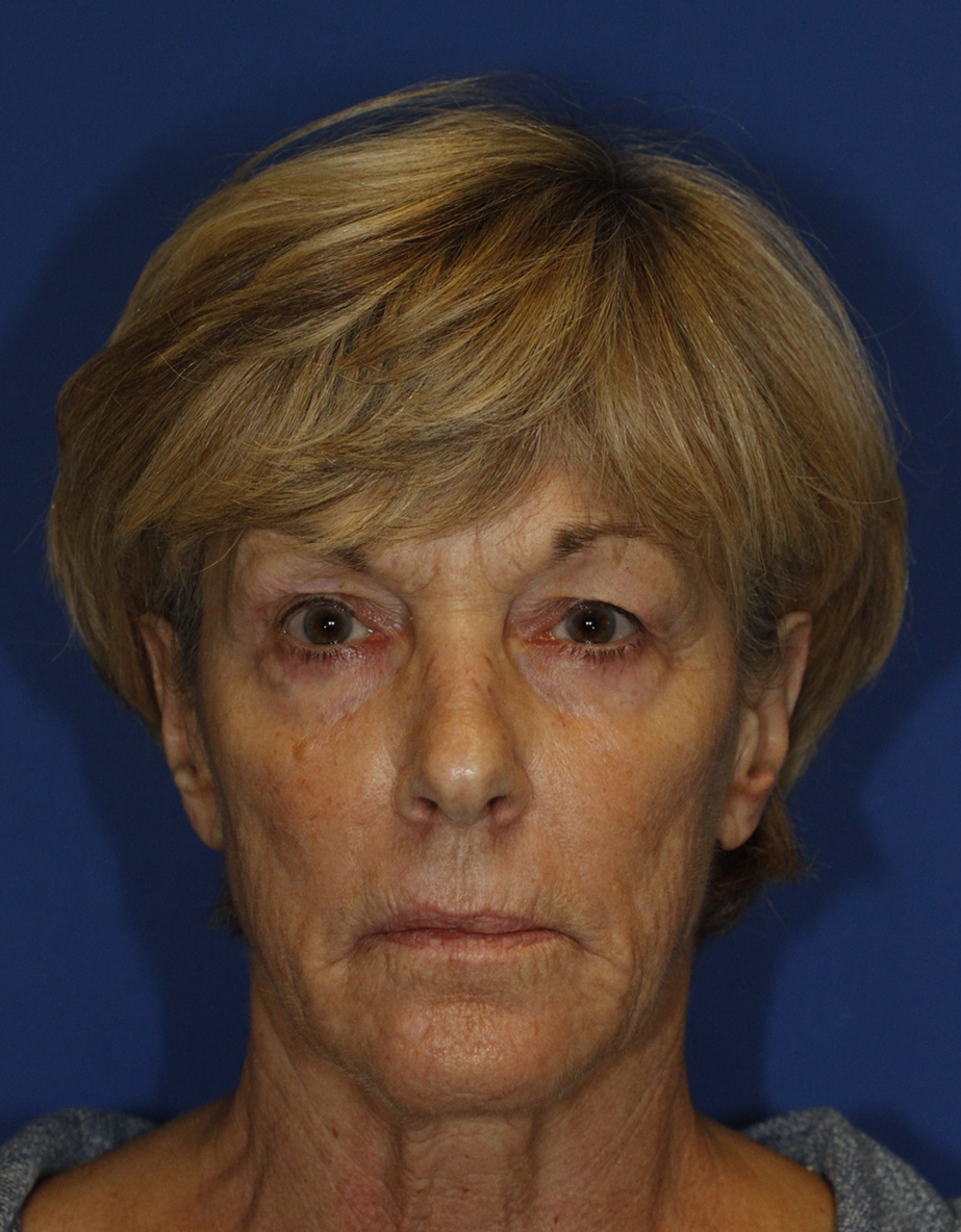 Before Blepharoplasty Frontal