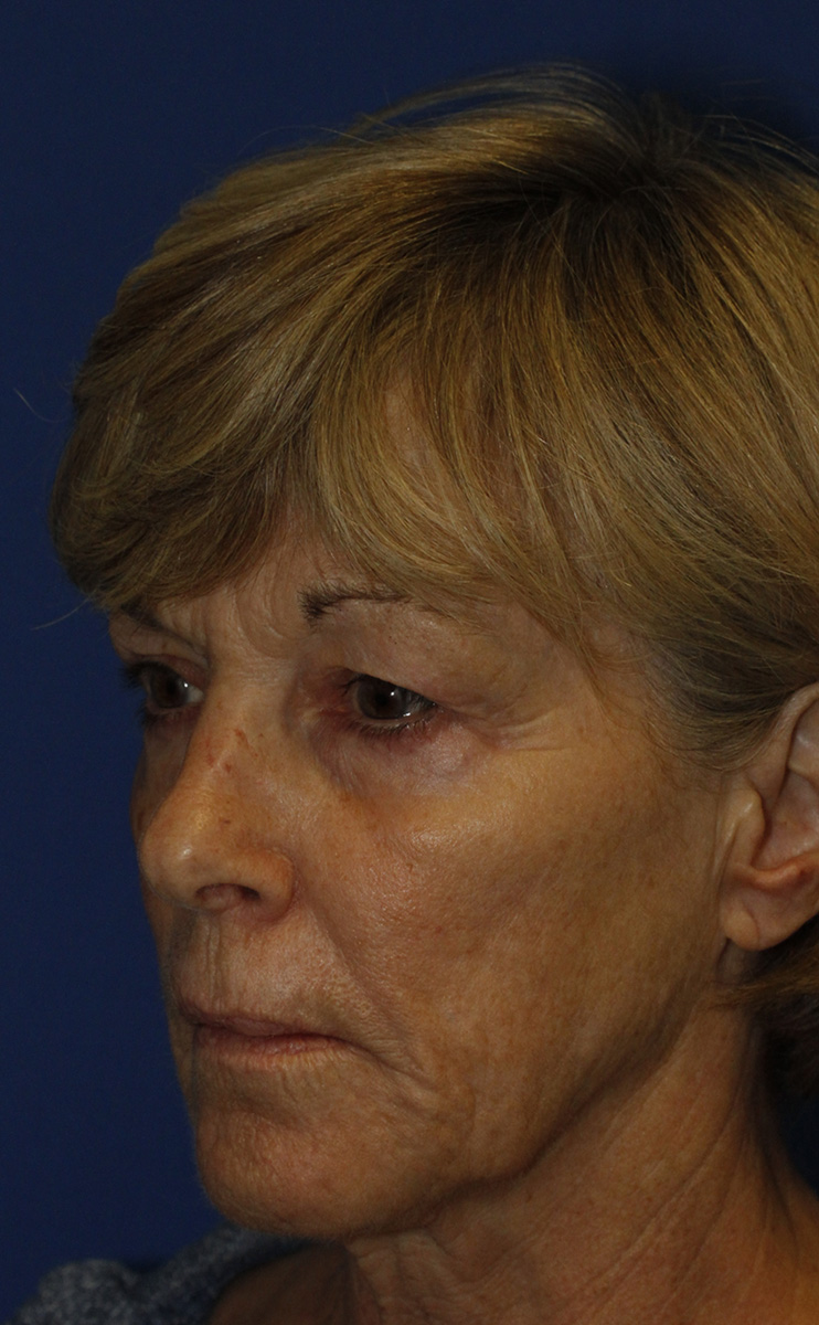 Before Blepharoplasty L Oblique