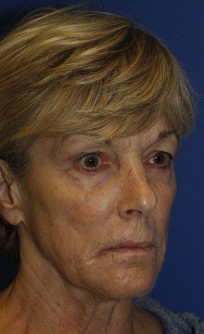 Before Blepharoplasty R Oblique