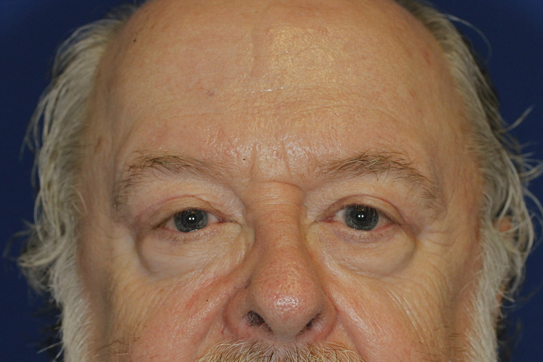 After Left Blepharoplasty and Ptosis Repair