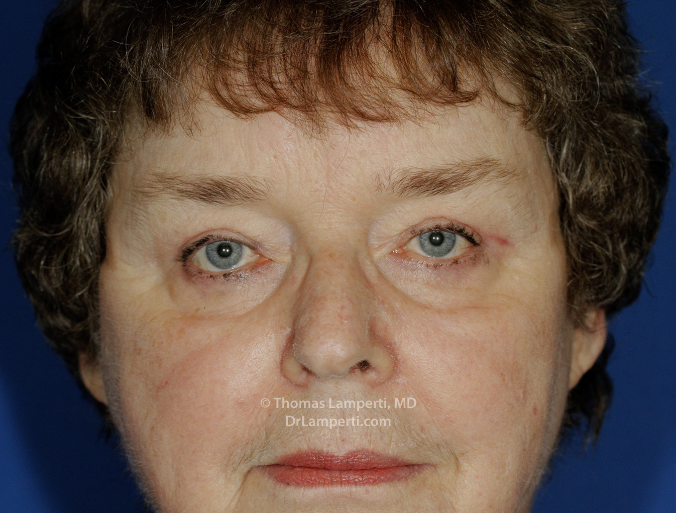 Blepharoplasty After Frontal