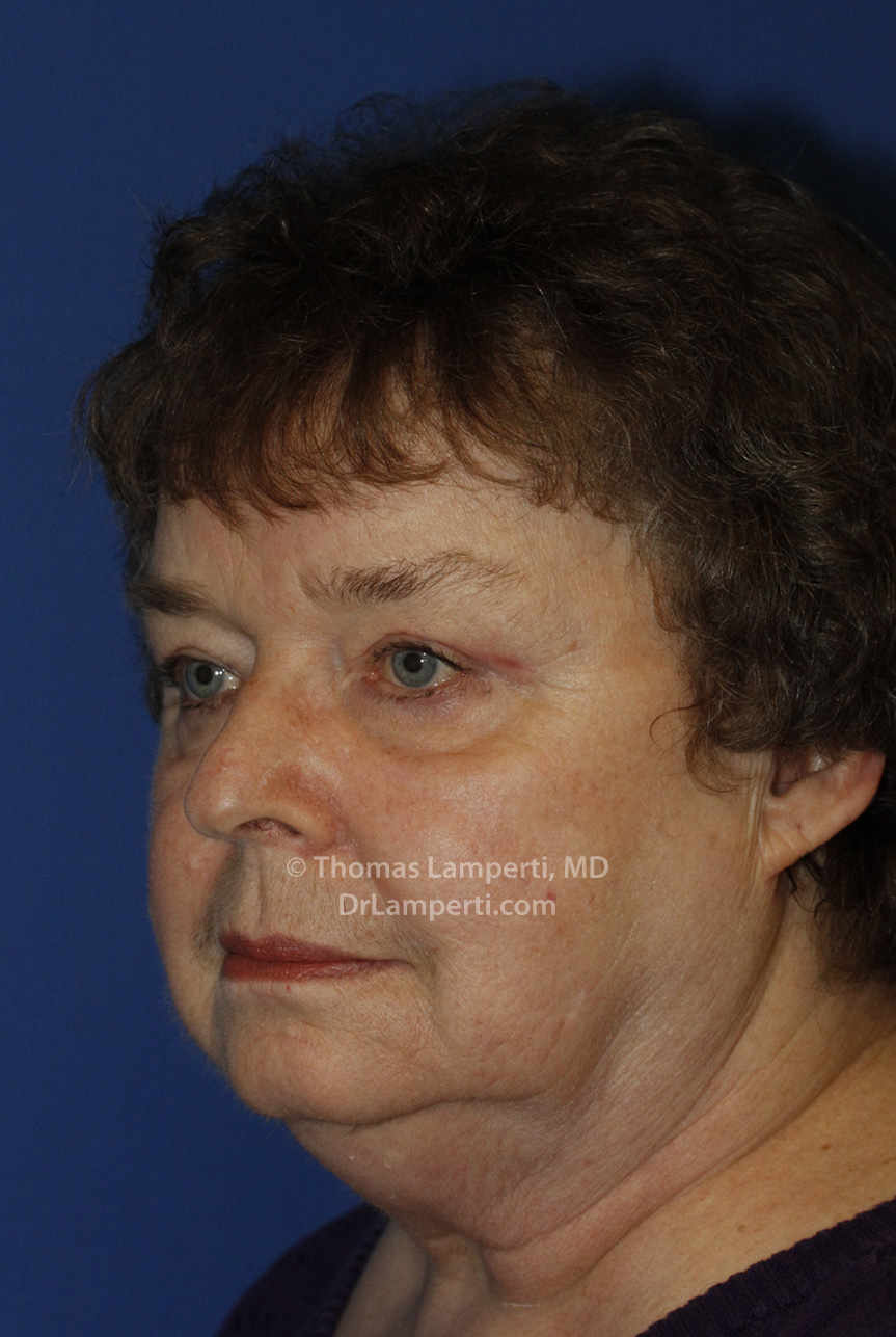 Blepharoplasty After R Oblique