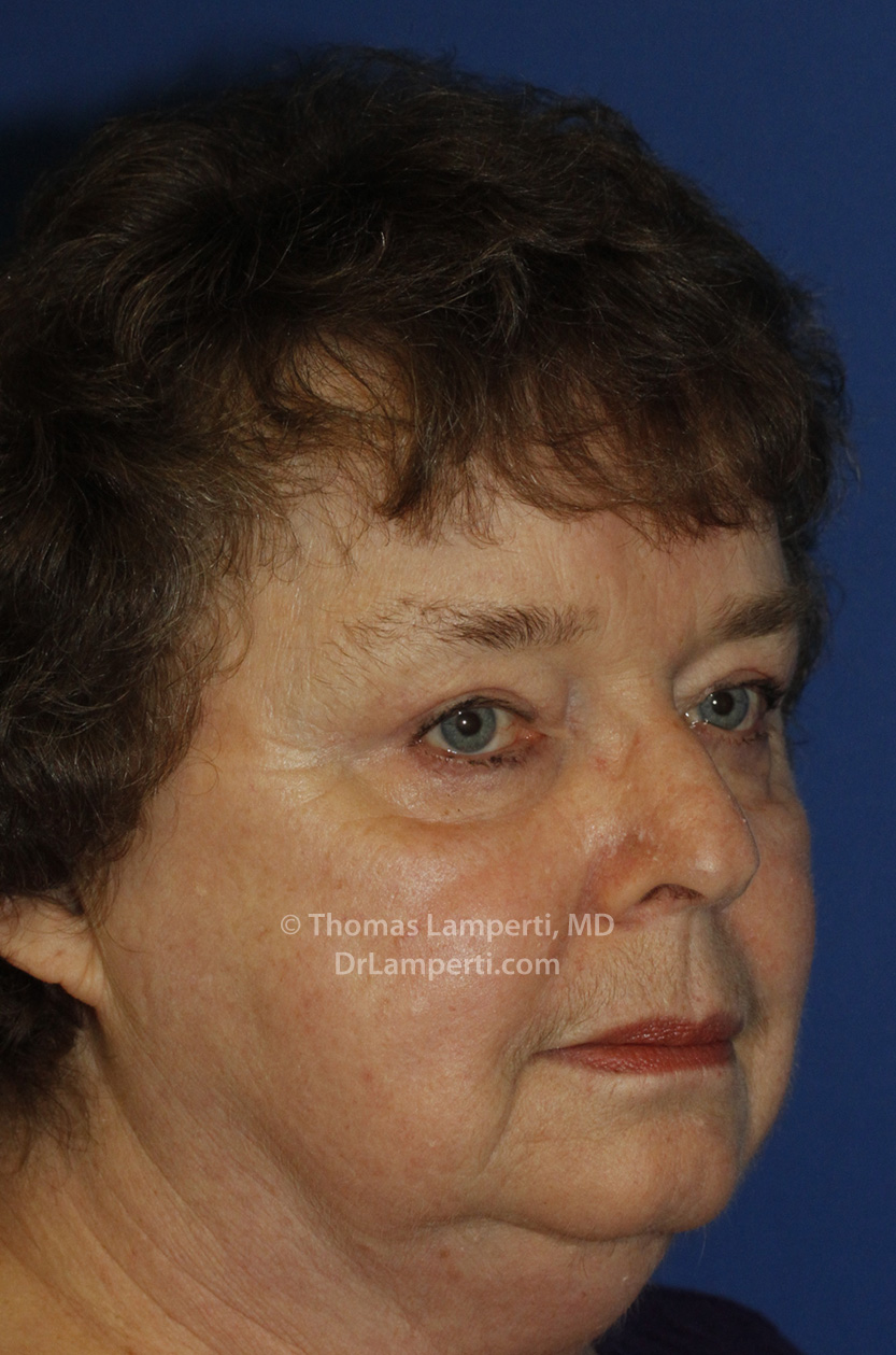 Blepharoplasty After L Oblique