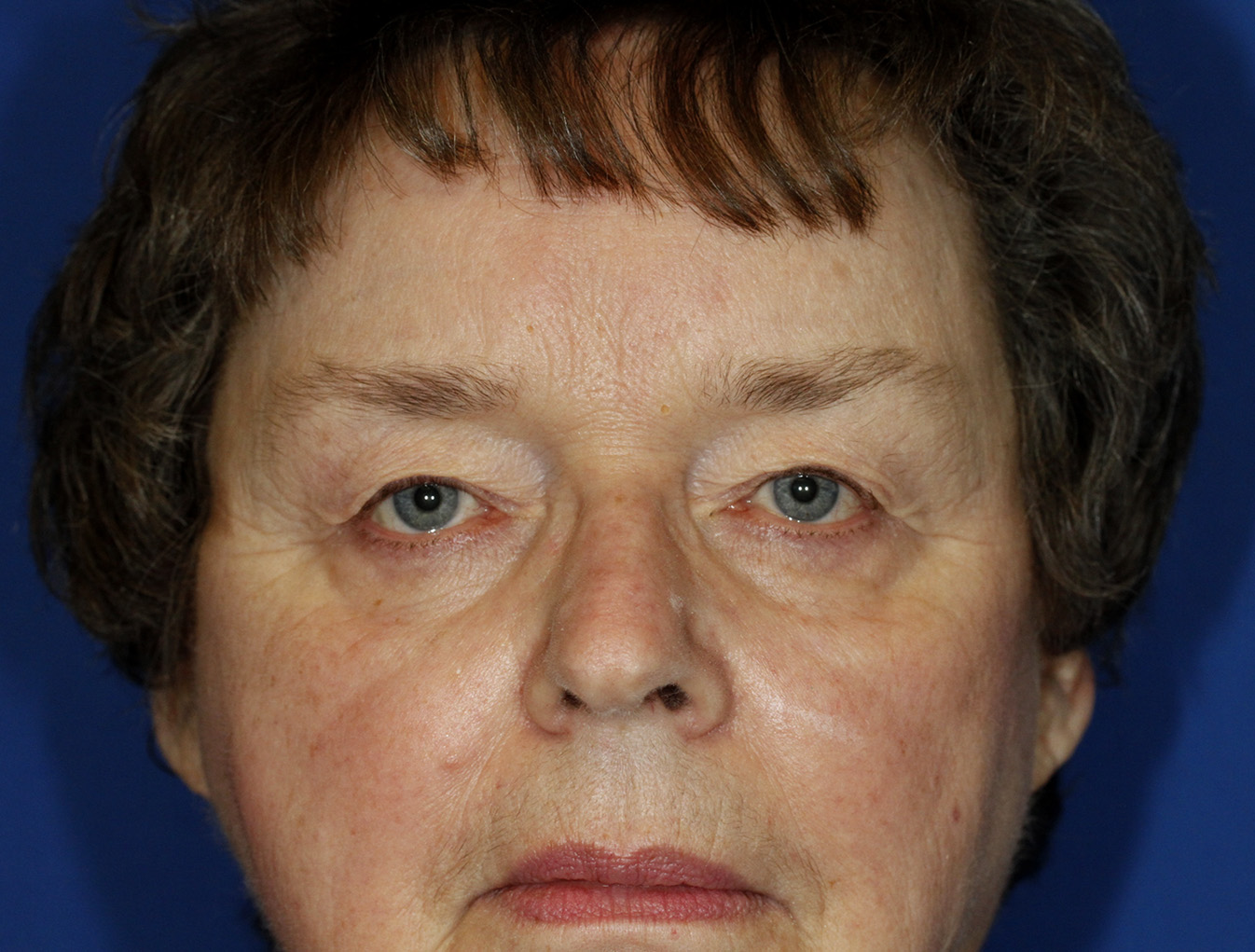 Blepharoplasty Before Frontal