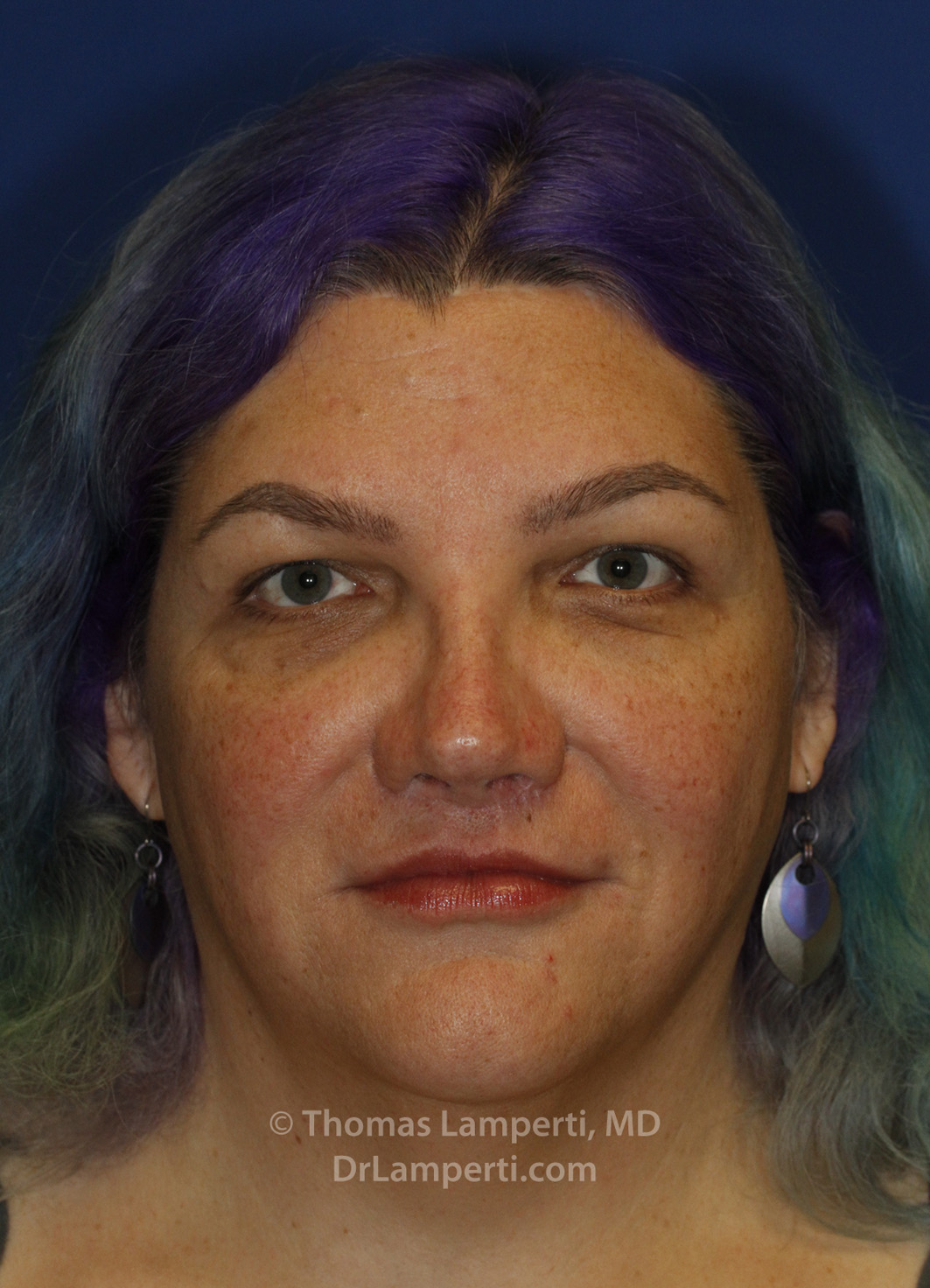 Blepharoplasty After Frontal