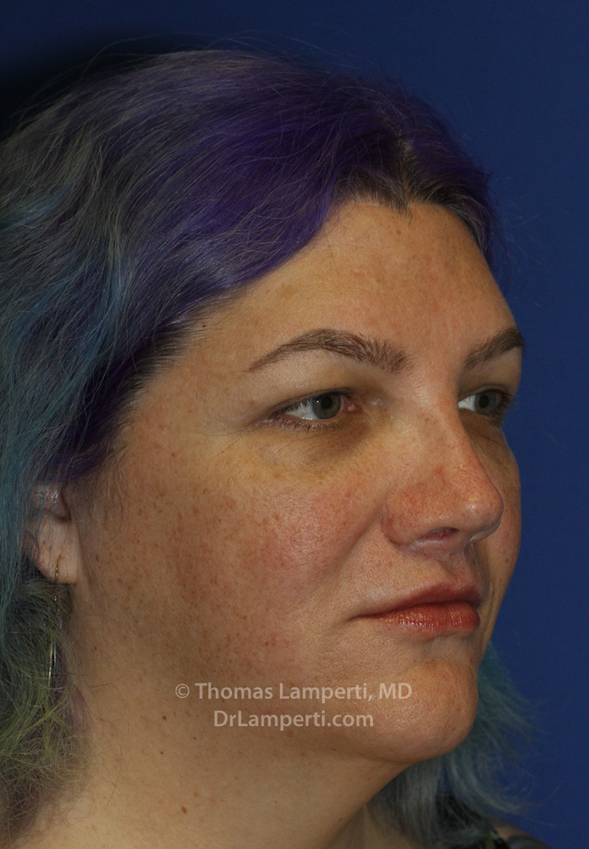 Blepharoplasty After R Oblique