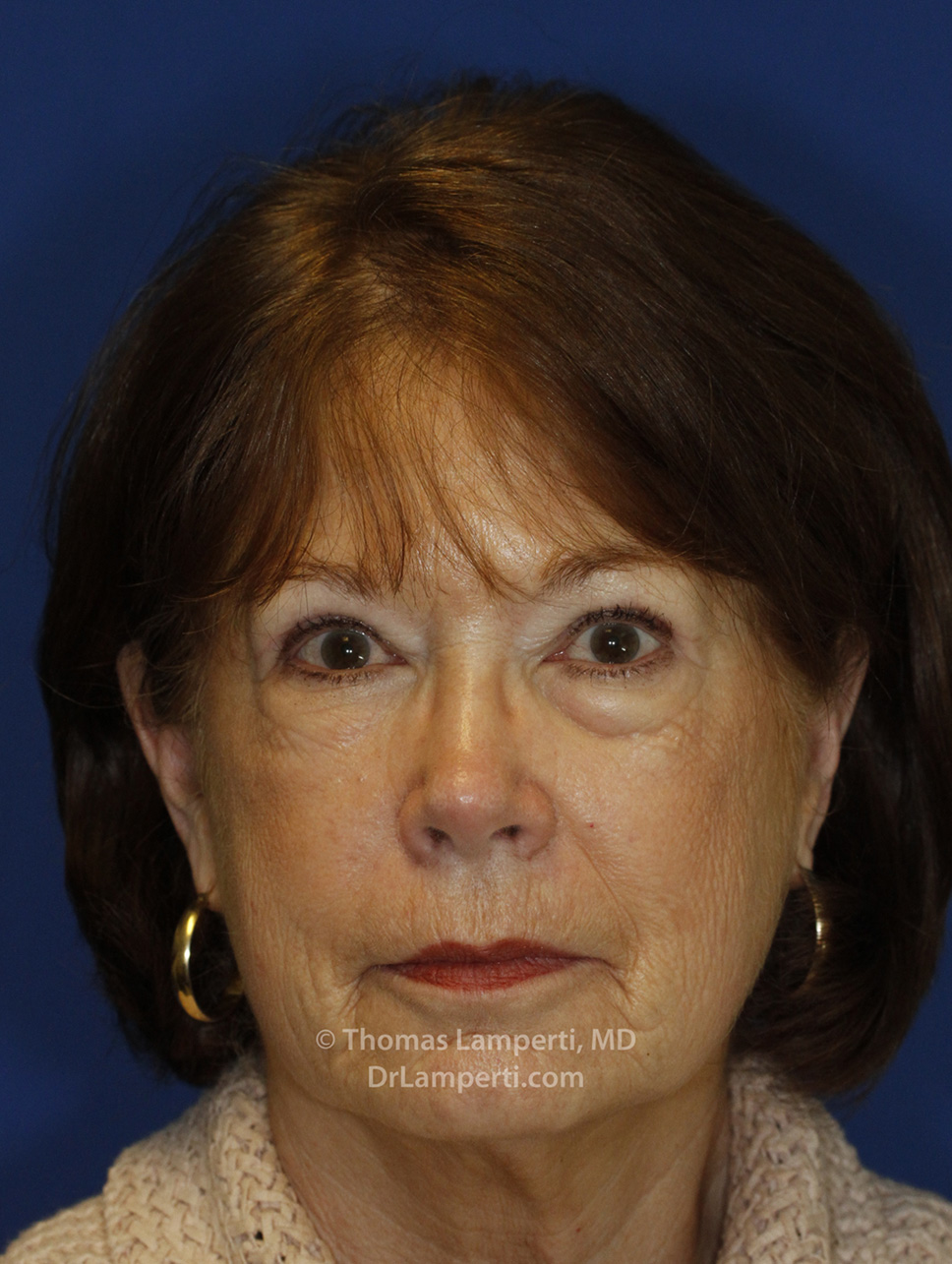 Blepharoplasty After Frontal