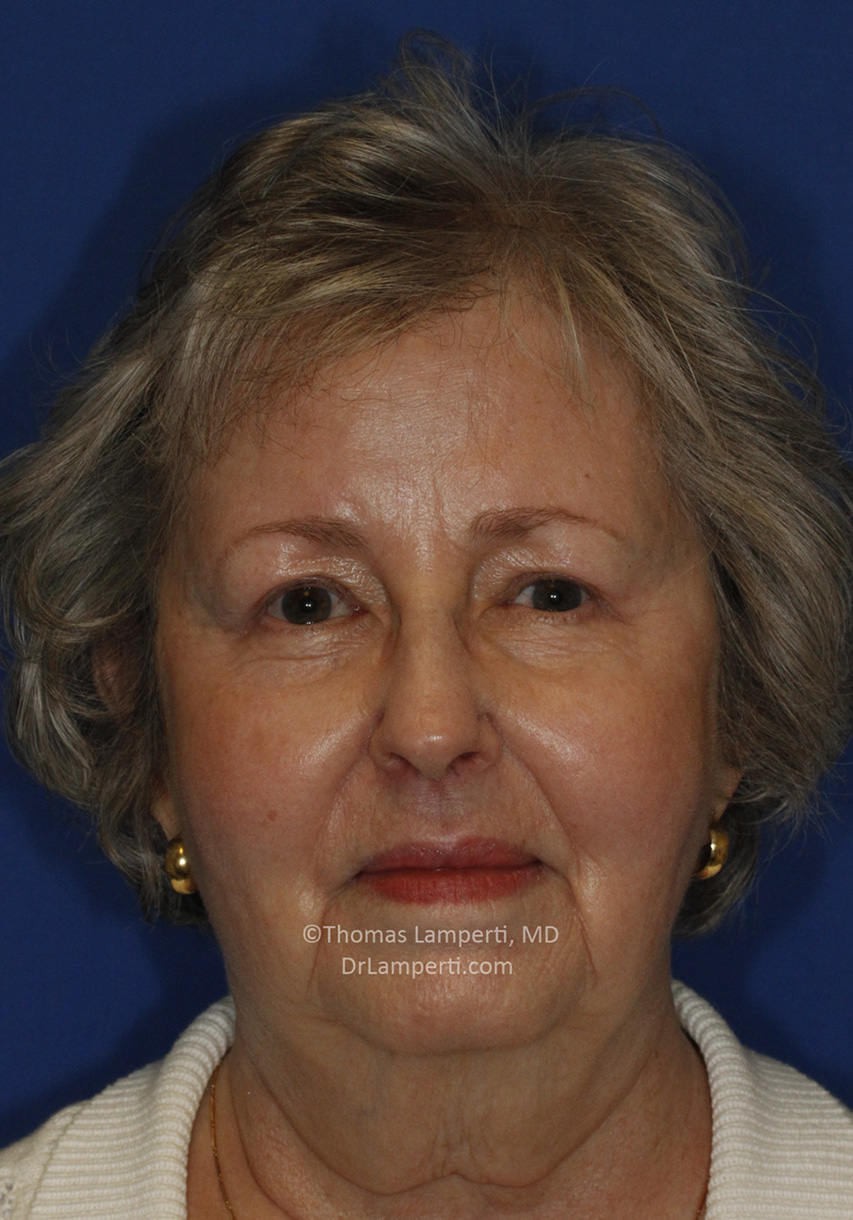 Blepharoplasty After Frontal