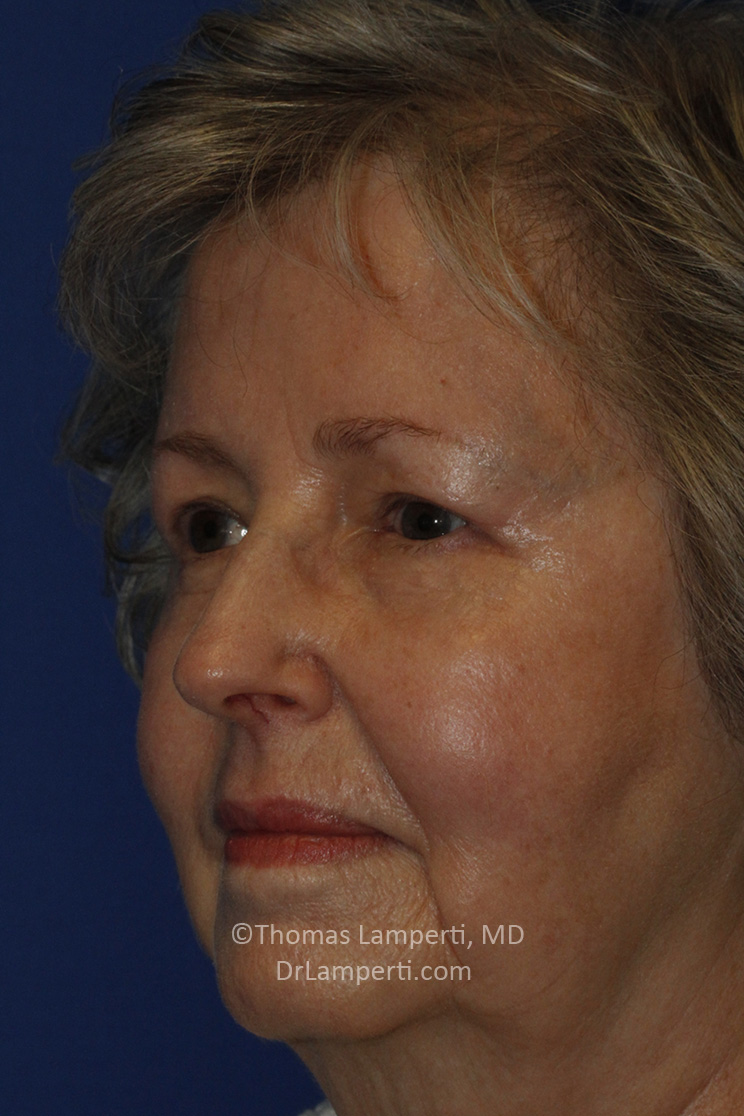 Blepharoplasty After L Oblique