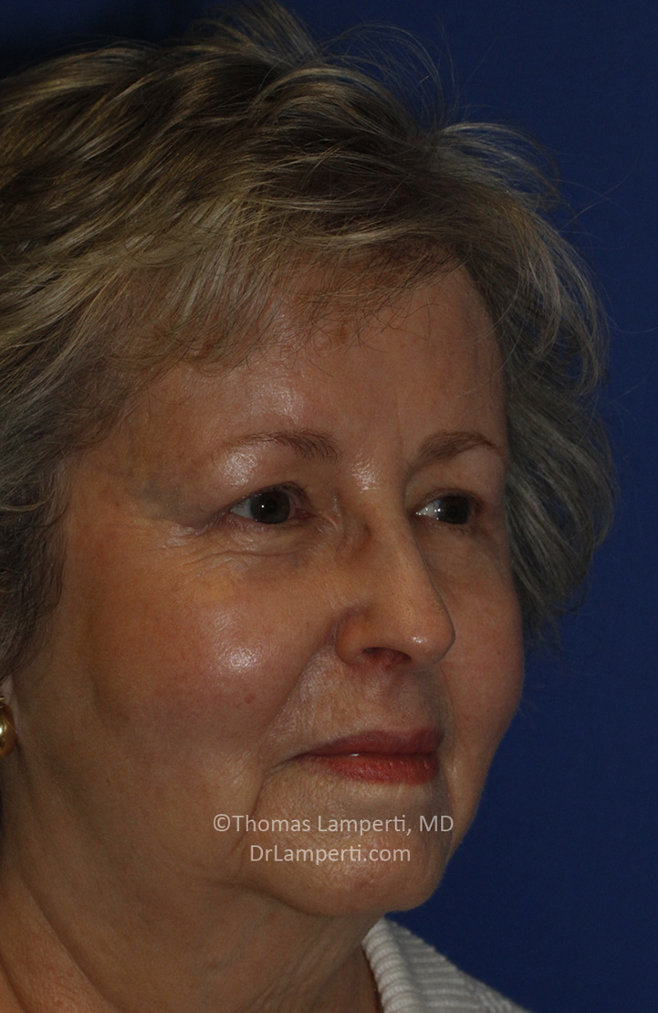 Blepharoplasty After R Oblique