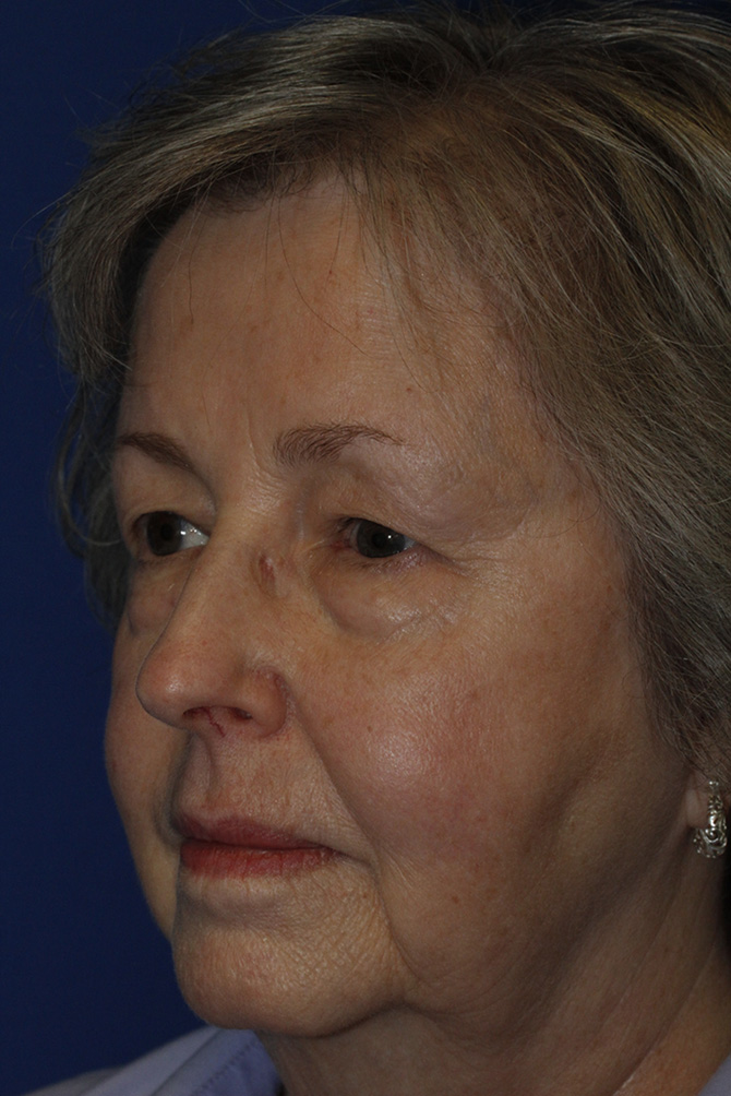 Blepharoplasty Before L Oblique