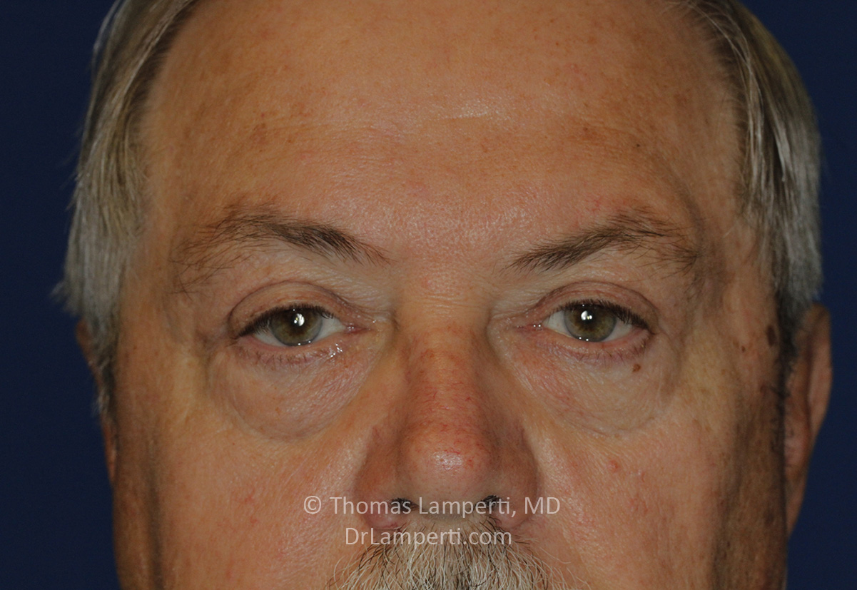 Blepharoplasty Frontal Detail After