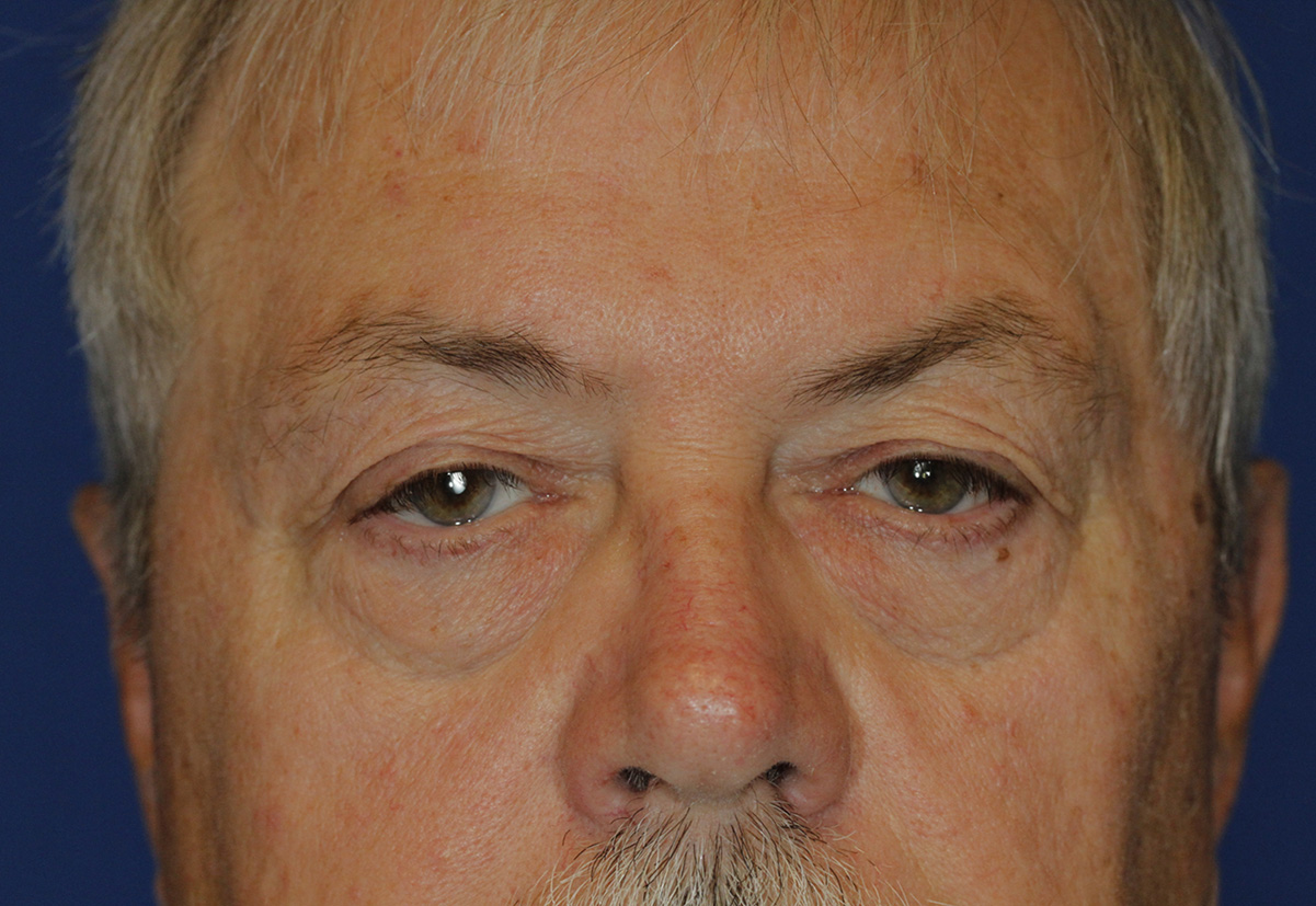 Blepharoplasty Frontal Detail Before