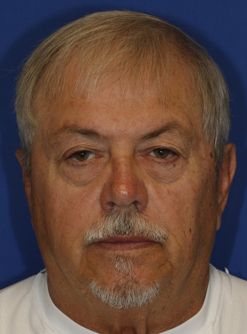 Blepharoplasty Frontal Before