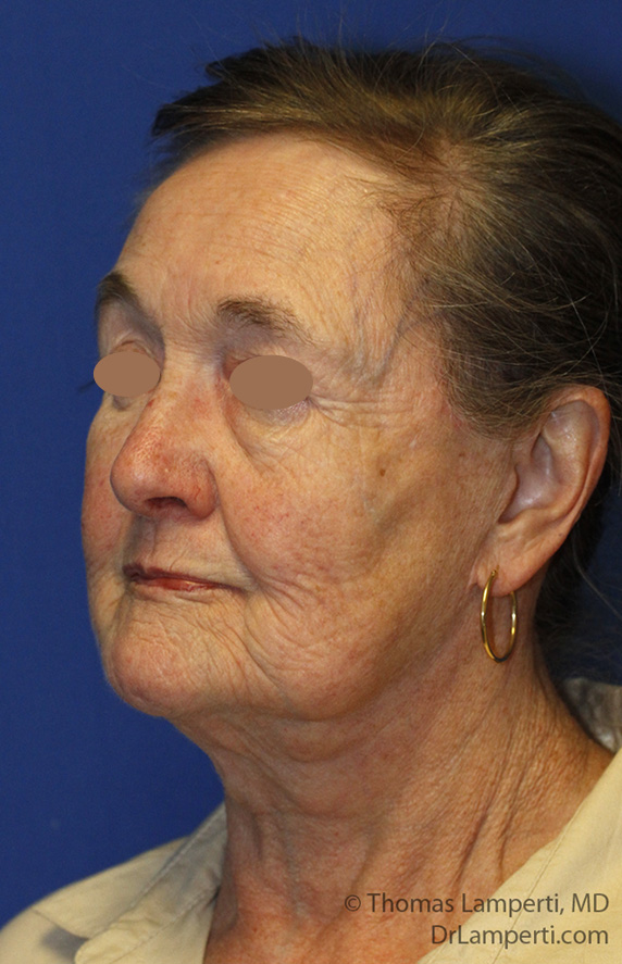 Lower Blepharoplasty After L Oblique