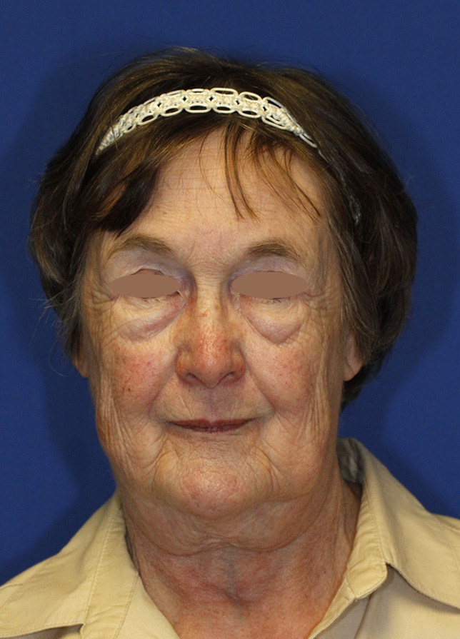 Lower Blepharoplasty Before Frontal